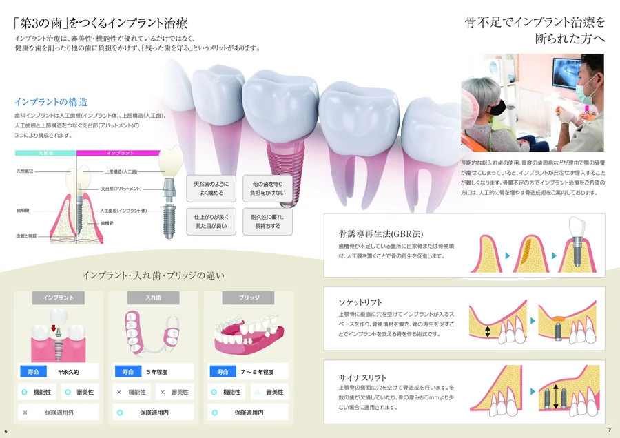 資料イメージ:インプラント治療の基本
